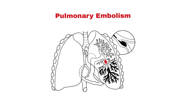 Exploring Pulmonary Embolism: Causes, Symptoms, and Risks